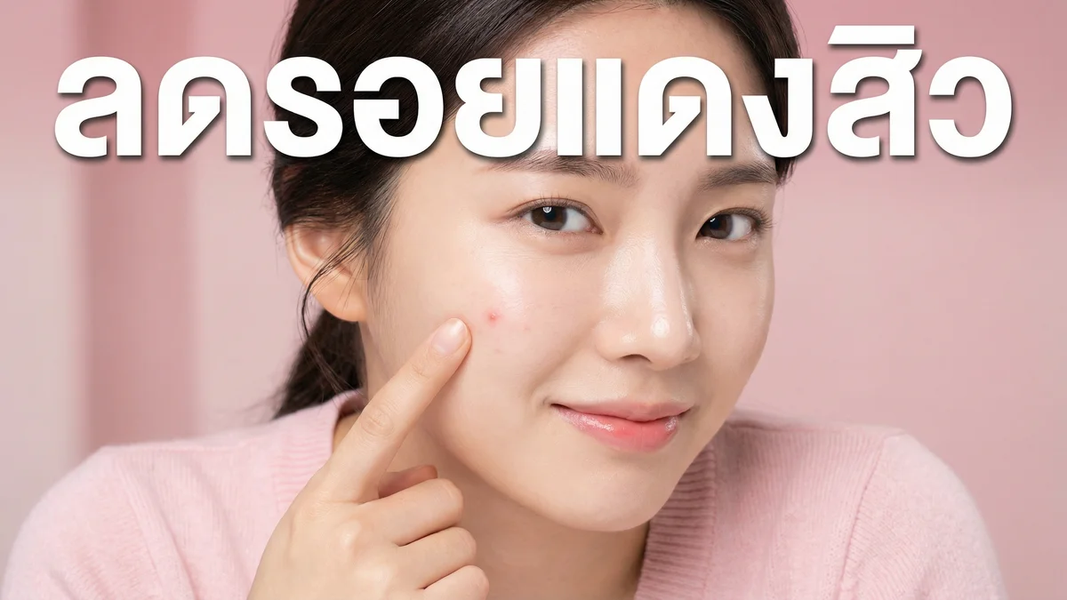 รอยแดงจากสิว หายยังไง — วิธีลดรอยแดง + ปกปิดระหว่างรักษา 2026 - บทความ Fleen Beauty